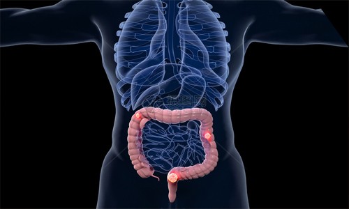 文獻(xiàn)解讀 | 單細(xì)胞轉(zhuǎn)錄組分析揭示了蛋白酪氨酸激酶在結(jié)直腸腫瘤發(fā)生過程中的作用