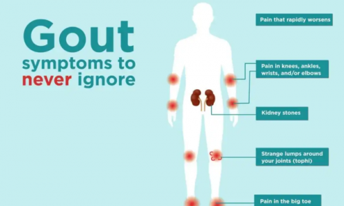 痛風(fēng)案例 |Olink 助力系統(tǒng)炎癥因子圖譜繪制與新靶點(diǎn)發(fā)現(xiàn)